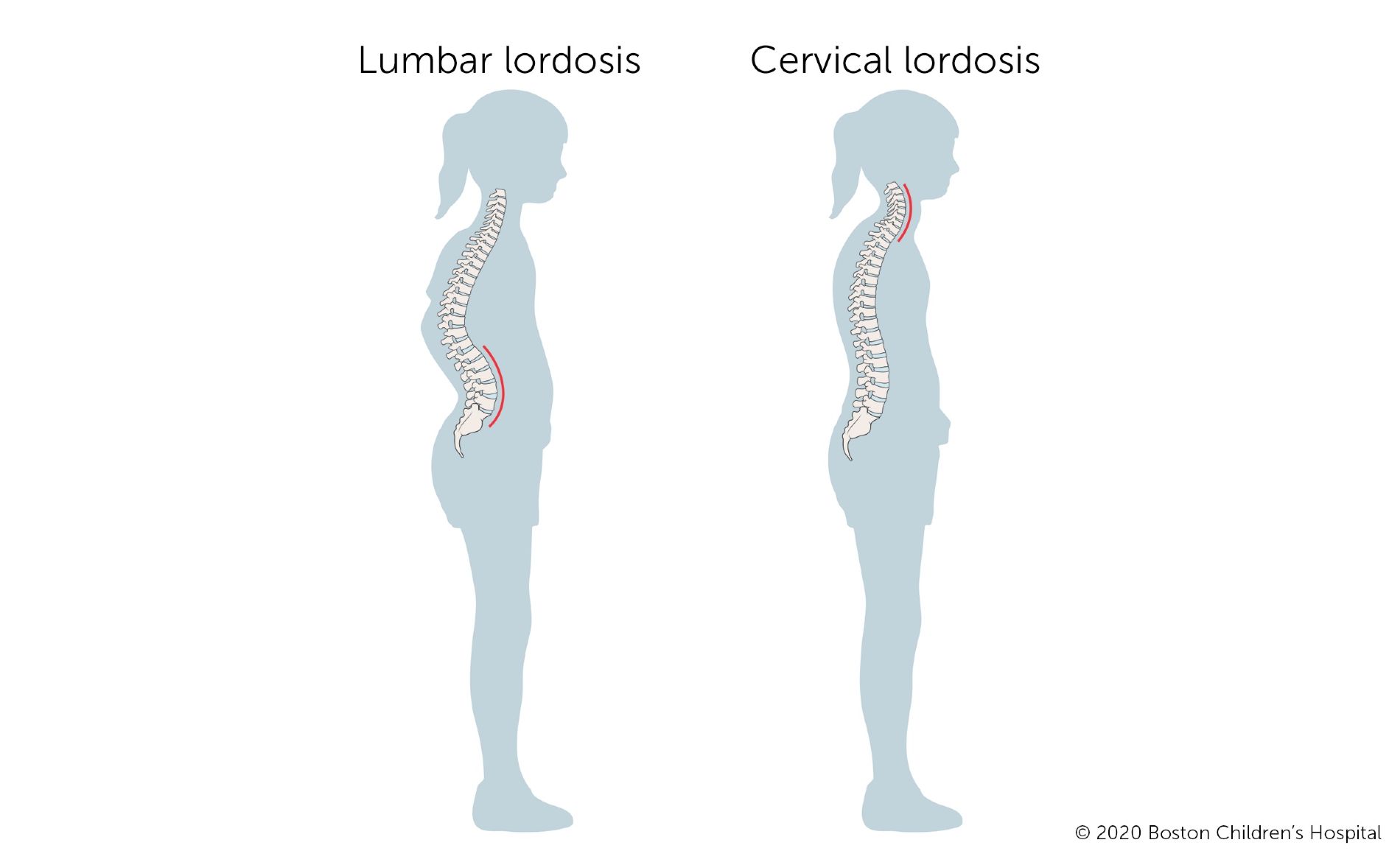 lordosis