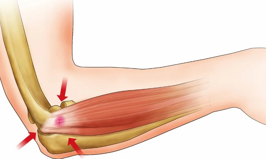 epicondilitis