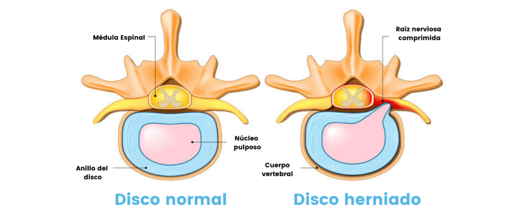 hernia discal