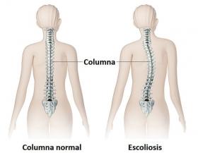 escoliosis