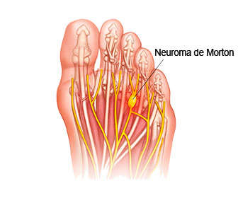 neuroma de morton