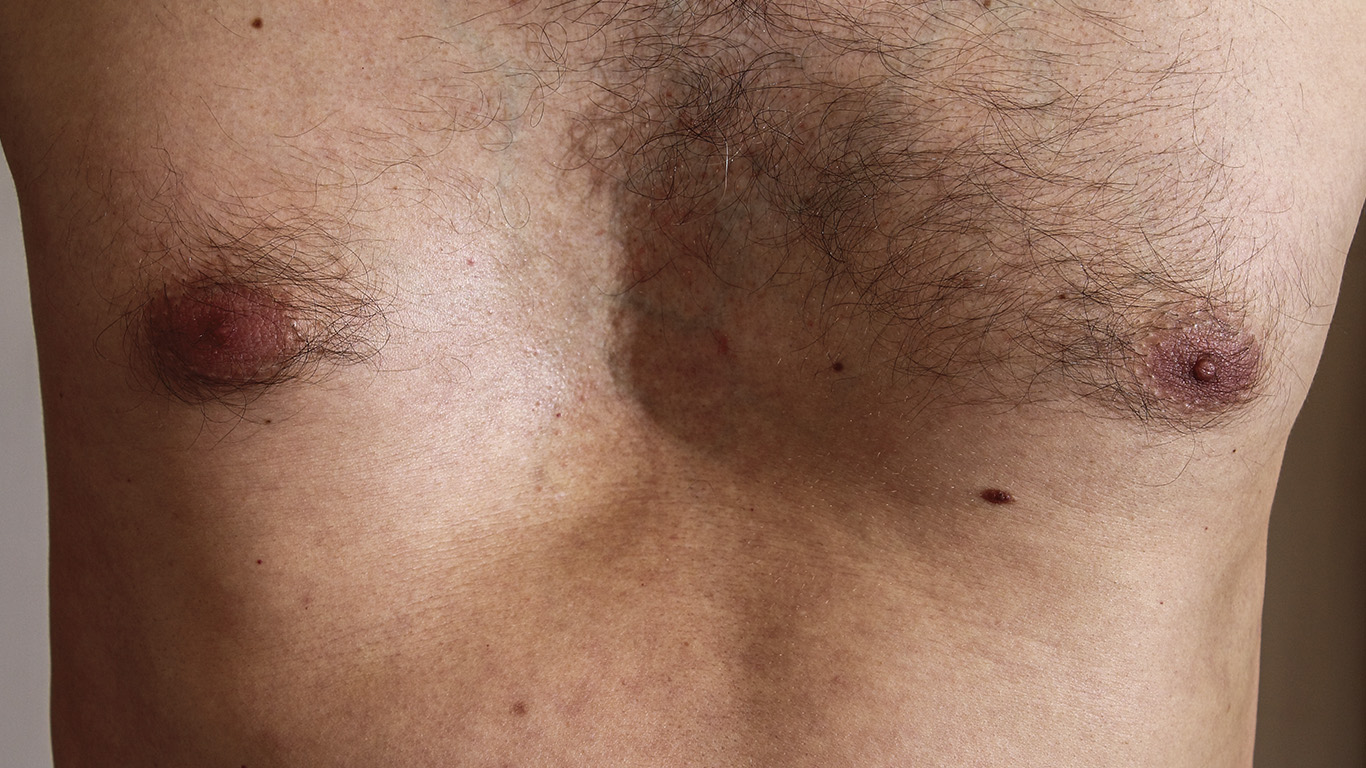 ortesis pectus excavatum